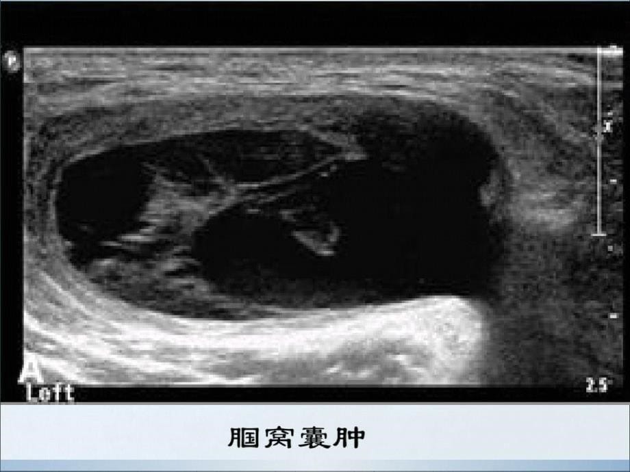 肌肉软组织肿物的超声诊断ppt课件[精选]_第5页