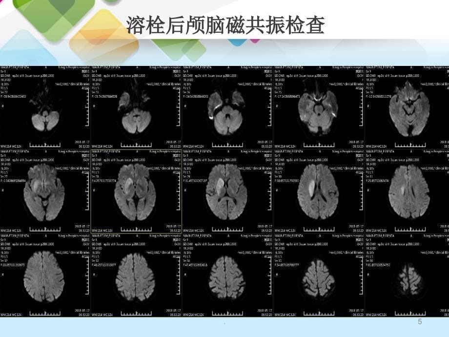 急性脑梗死动脉取栓治疗(1)_第5页