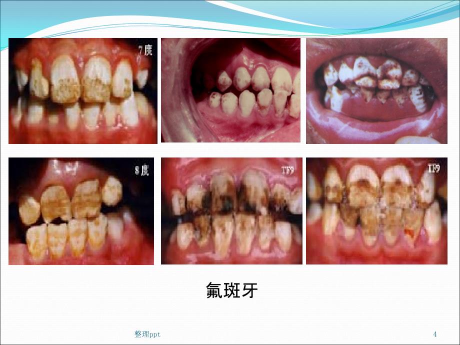 预防氟中毒(1)_第4页