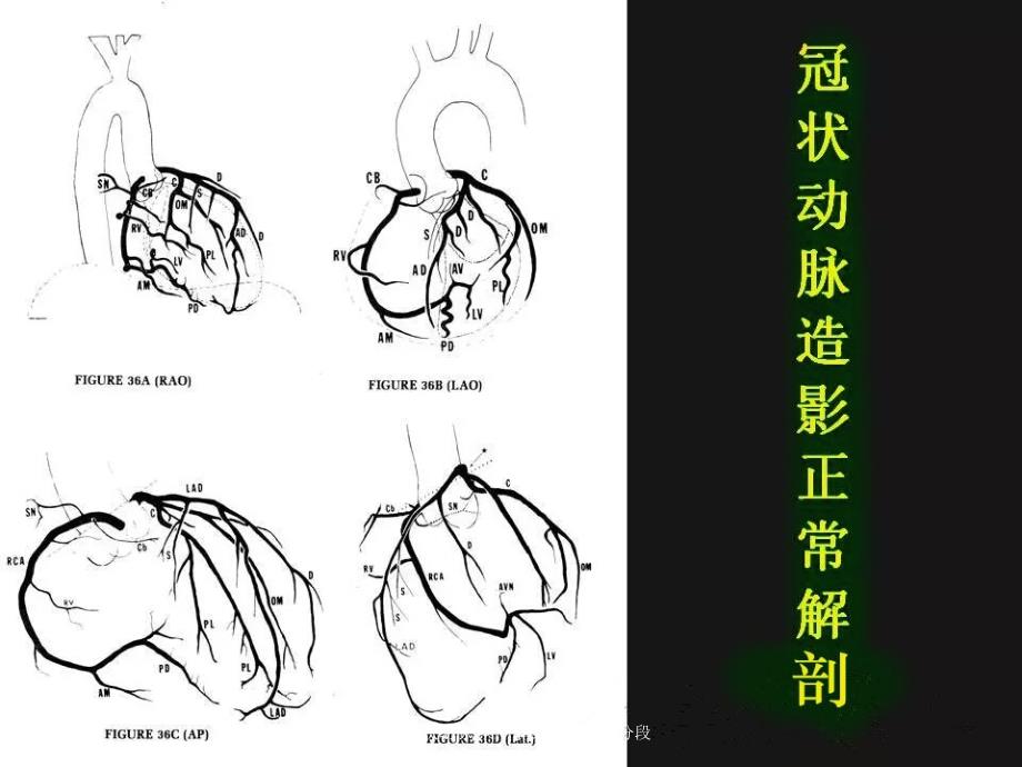 最新最新冠状动脉解剖 精细到每一个分段_第2页