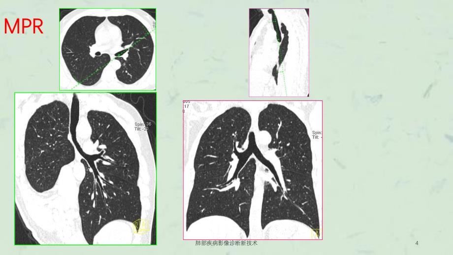 肺部疾病影像诊断新技术课件_第4页