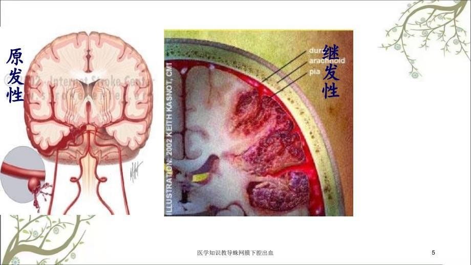 医学知识教导蛛网膜下腔出血课件_第5页