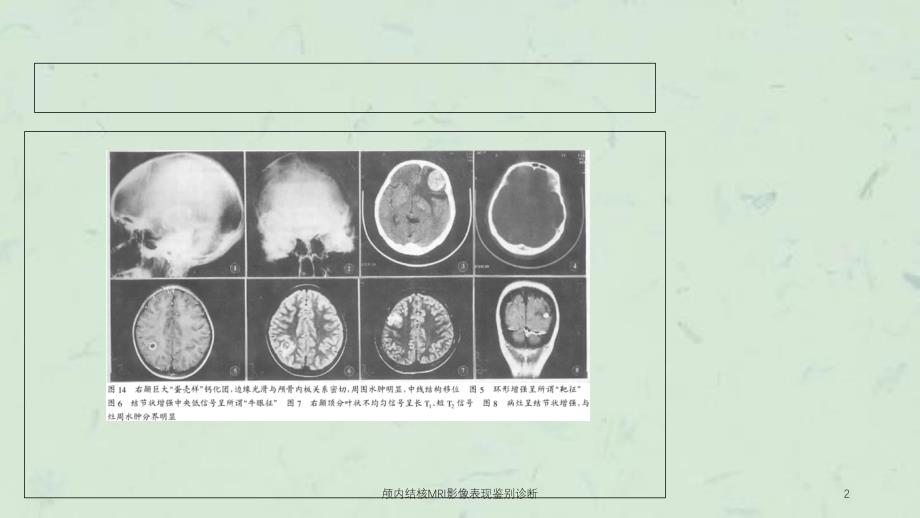 颅内结核MRI影像表现鉴别诊断课件_第2页