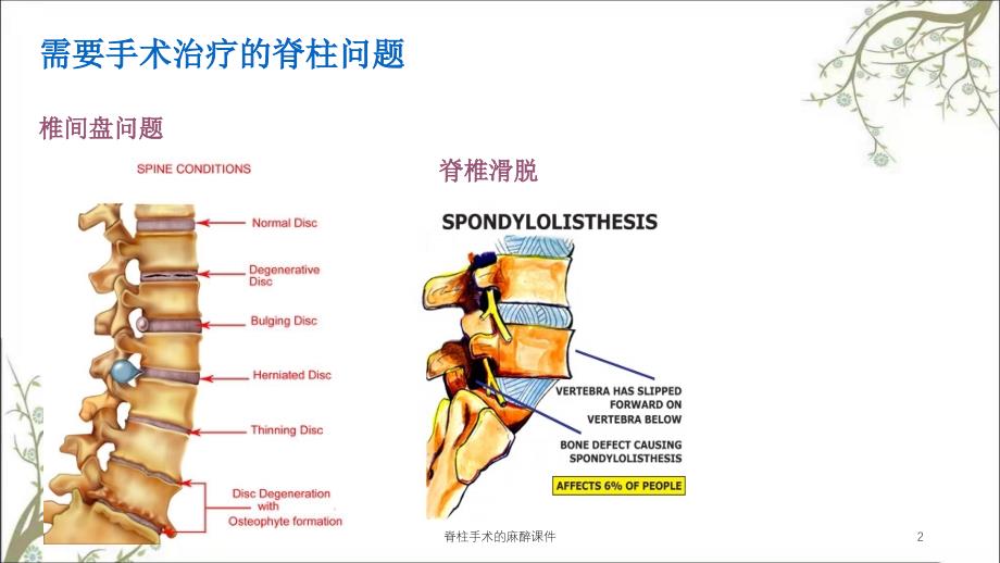 脊柱手术的麻醉课件_第2页