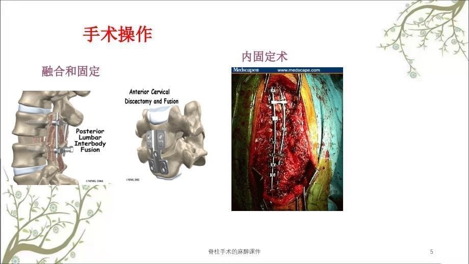 脊柱手术的麻醉课件_第5页