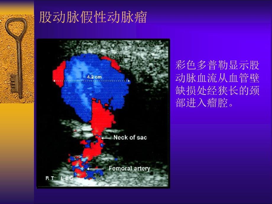 pci的并发症课件（完整）ppt[精选]_第3页