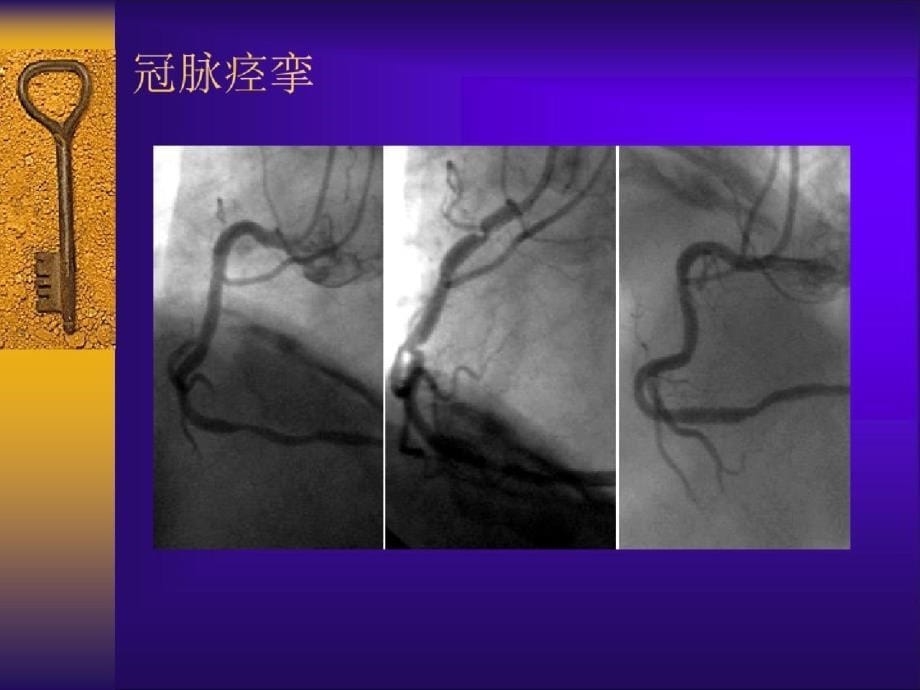 pci的并发症课件（完整）ppt[精选]_第5页