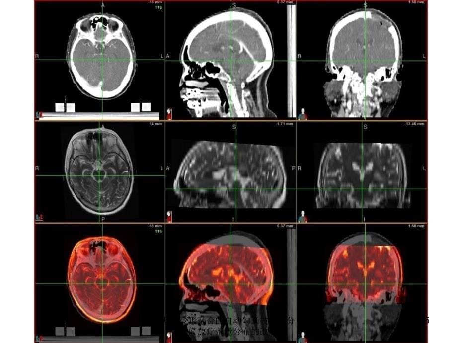基于变形融合的自动勾画技术与分次间放疗剂量分布的改变_第5页