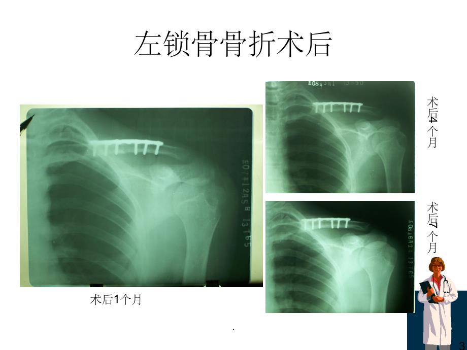 《骨折x线片汇总》(2)_第3页