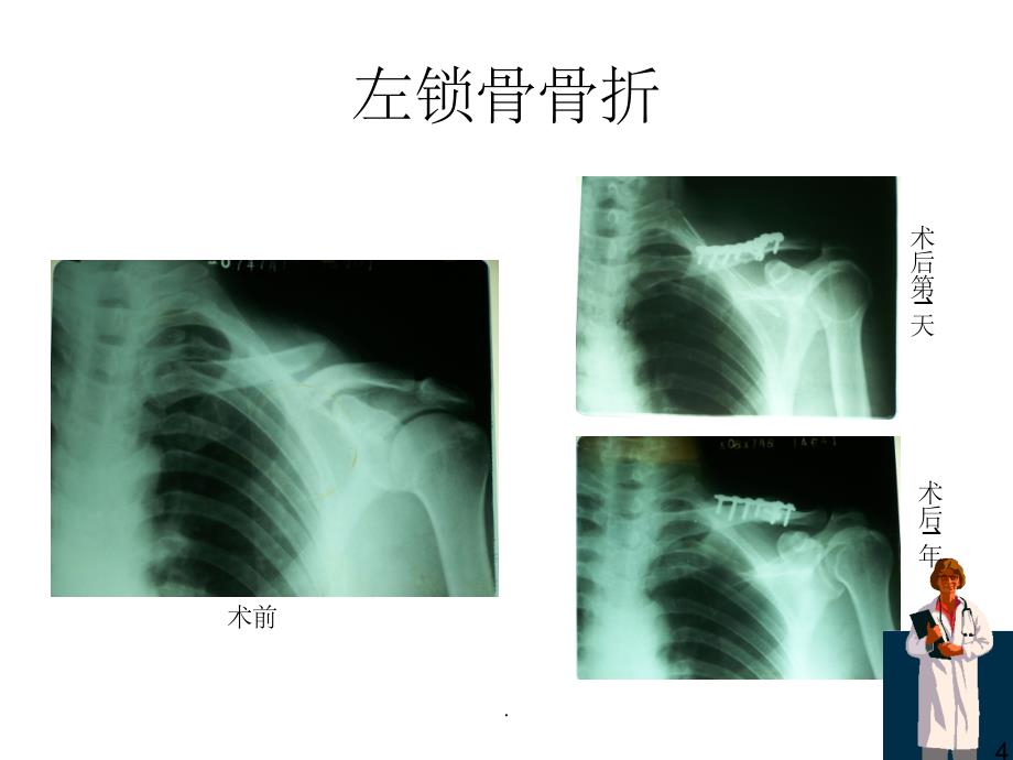 《骨折x线片汇总》(2)_第4页