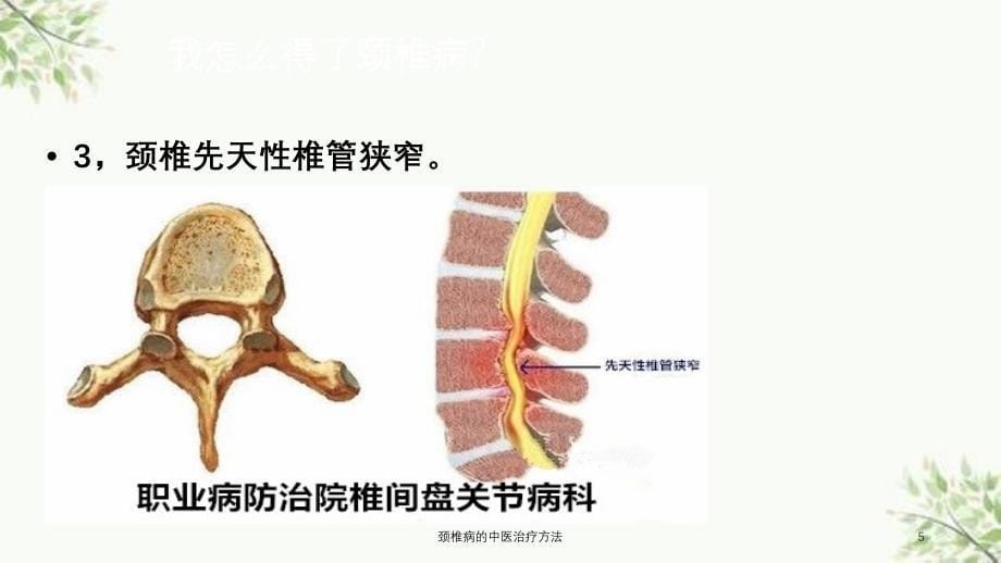 颈椎病的中医治疗方法课件_第5页