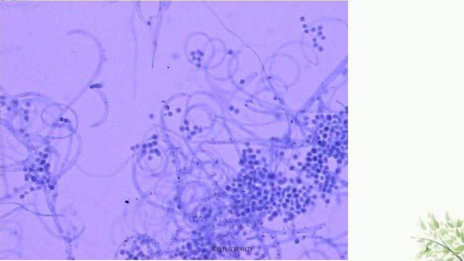 真菌性皮肤病(2)课件_第5页