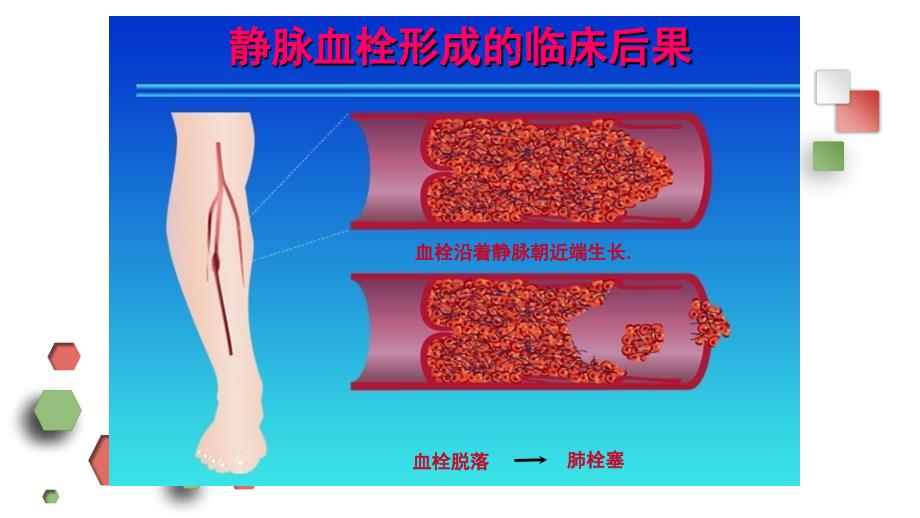 围手术期下肢深静脉血栓的预防及护理_第2页