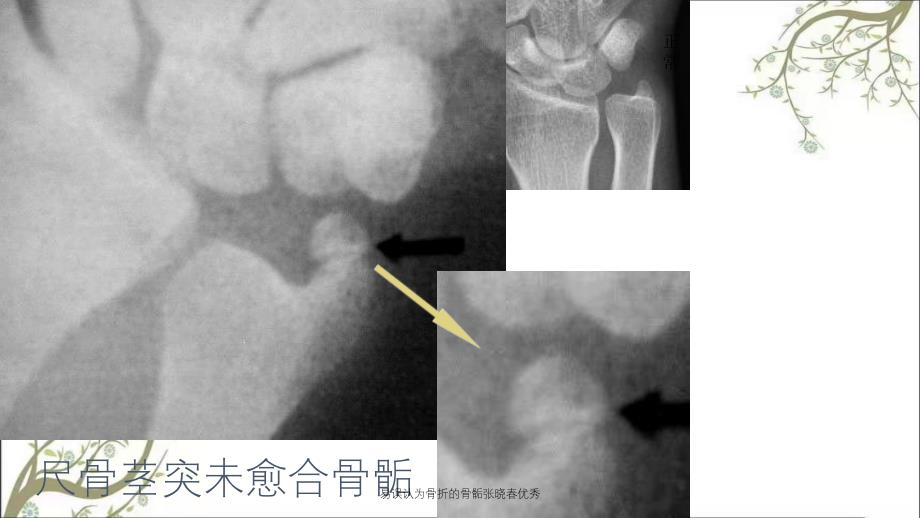 易误认为骨折的骨骺张晓春优秀_第3页