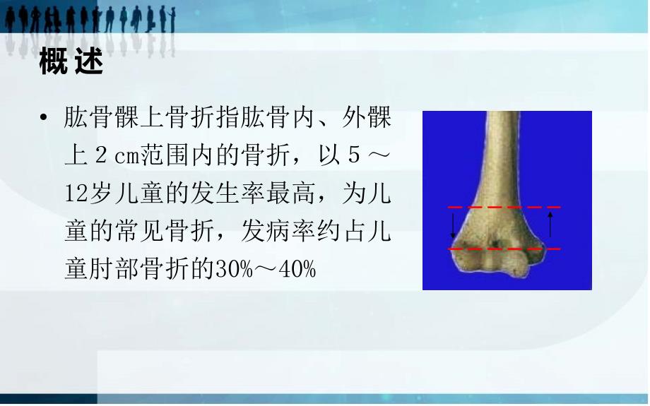 肱骨髁上骨折 (3)_第2页