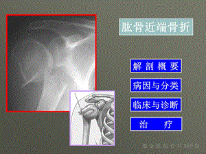 肱骨近端骨折 (3)