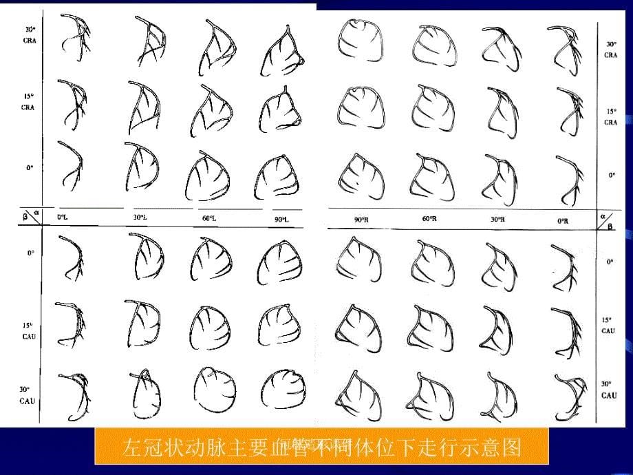 冠脉造影课件_第5页