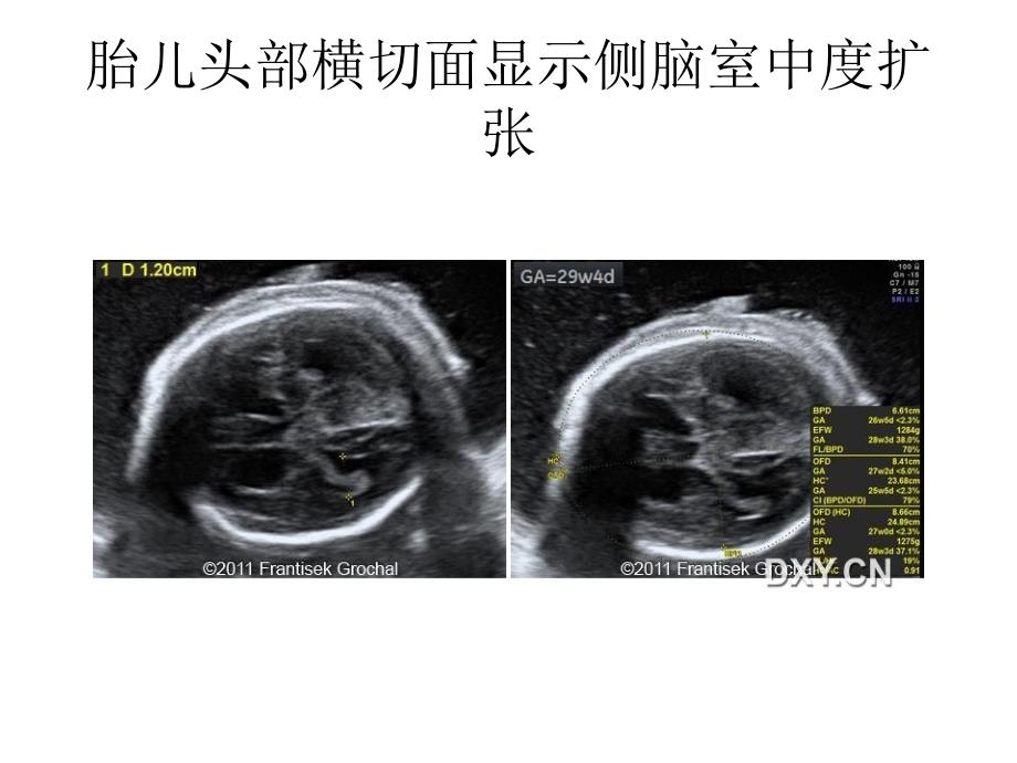 史-伦-奥三氏综合征幻灯片资料_第3页