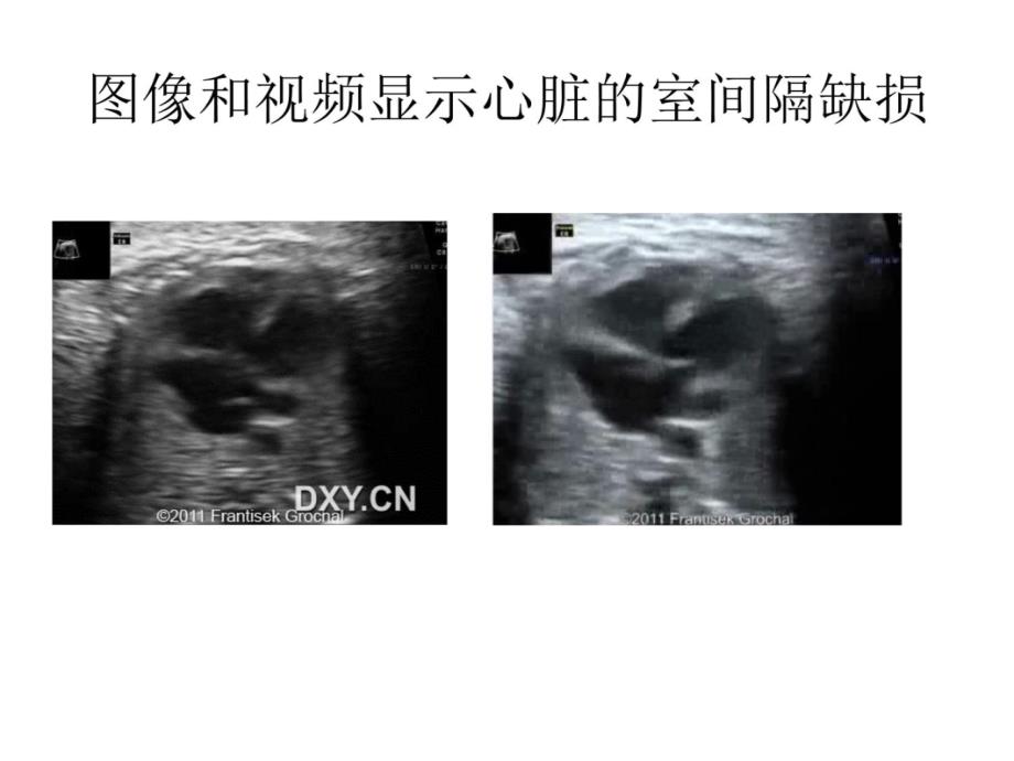 史-伦-奥三氏综合征幻灯片资料_第4页