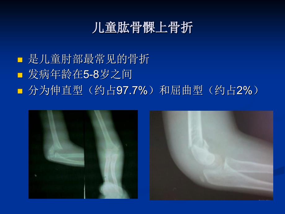 儿童肘关节创伤的诊断和治疗备课讲稿_第2页