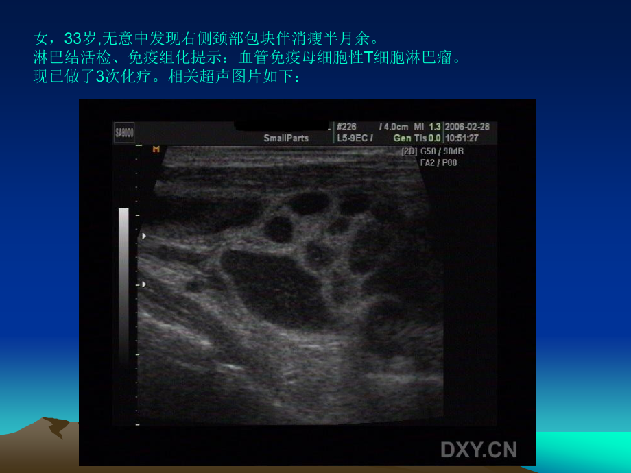 1淋巴瘤的超声诊断3幻灯片课件_第3页