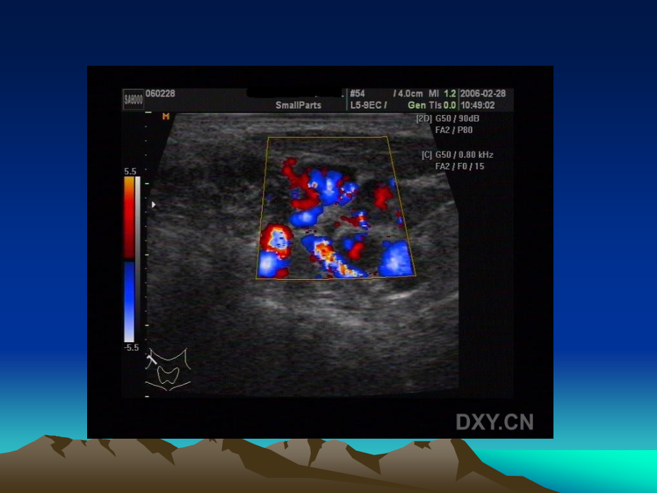 1淋巴瘤的超声诊断3幻灯片课件_第5页