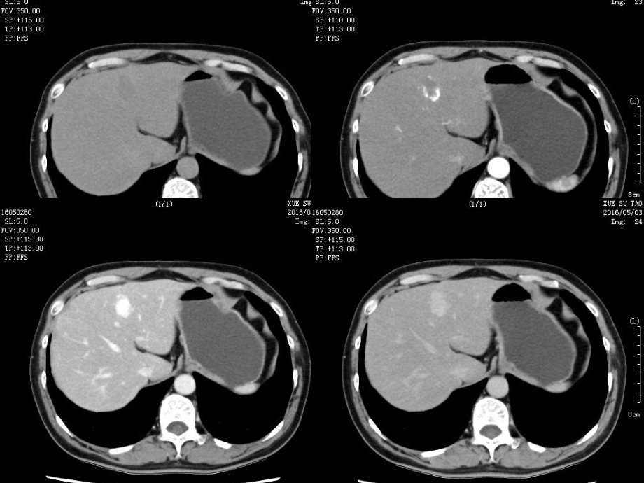 胆管细胞癌与肝脓肿影像鉴别PPT课件_第2页