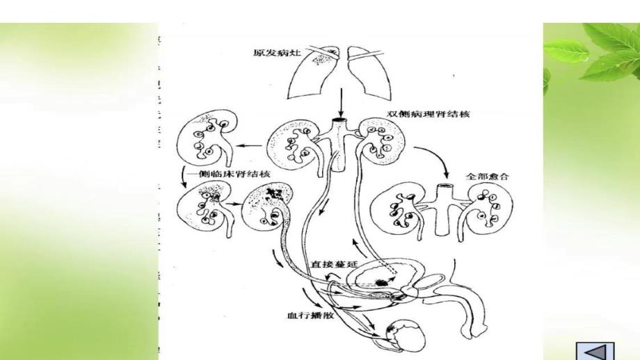 肾结核患者的护理_第4页