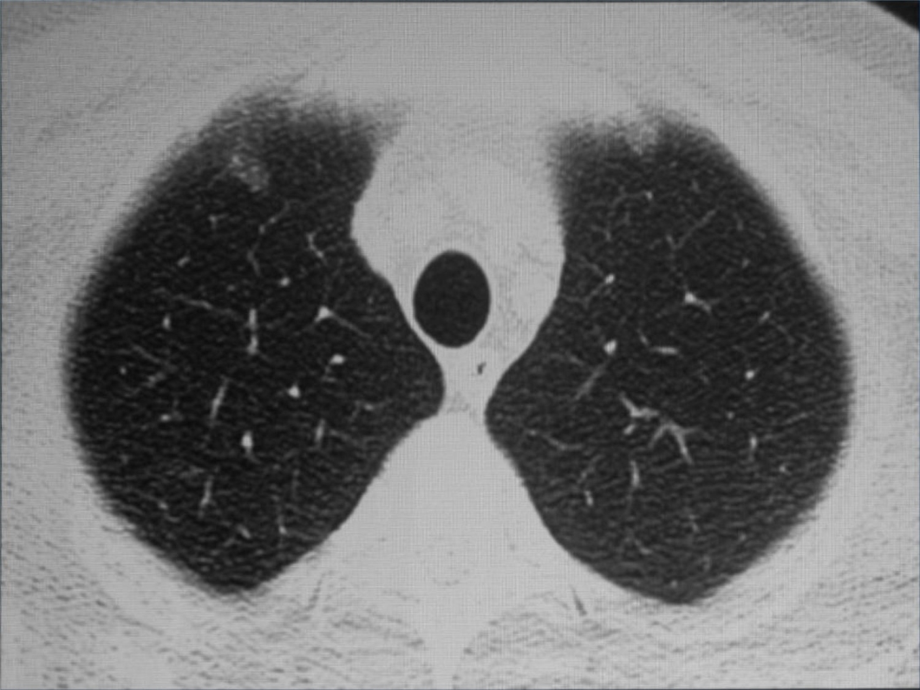 孤立性肺结节的CT诊断 (2)4资料教程_第4页