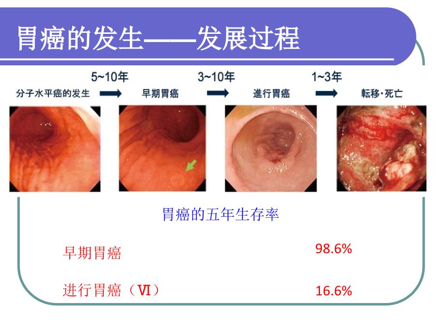 早期胃癌诊断的一点体会8培训教材_第3页