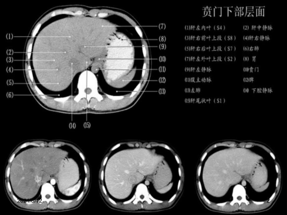 小时读懂腹部CT讲座_第2页