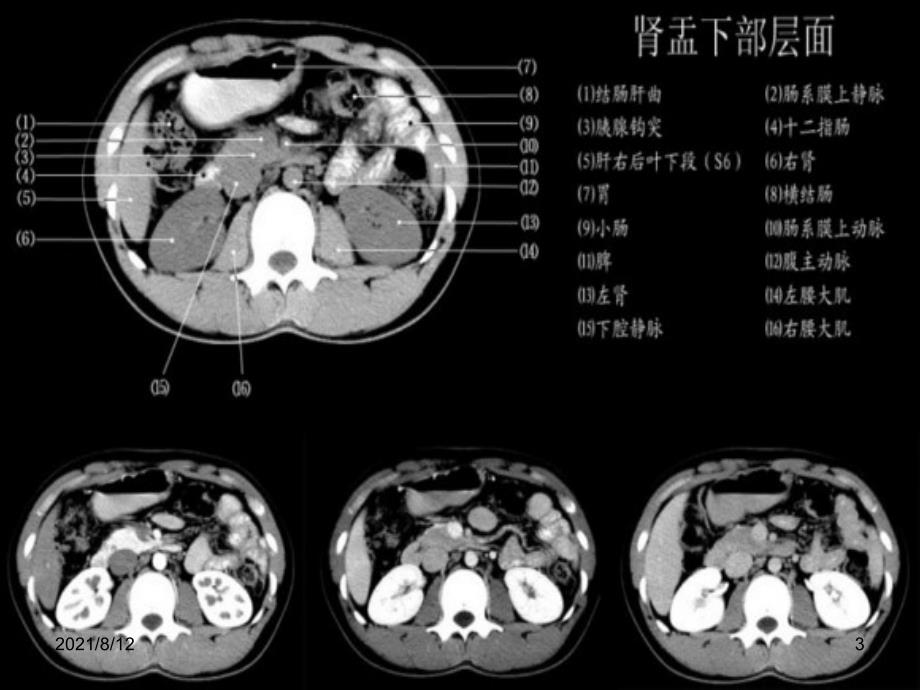 小时读懂腹部CT讲座_第3页