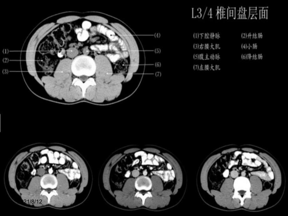 小时读懂腹部CT讲座_第4页