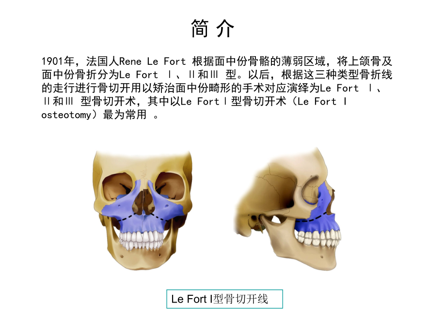 常用正颌外科手术PPT课件_第5页