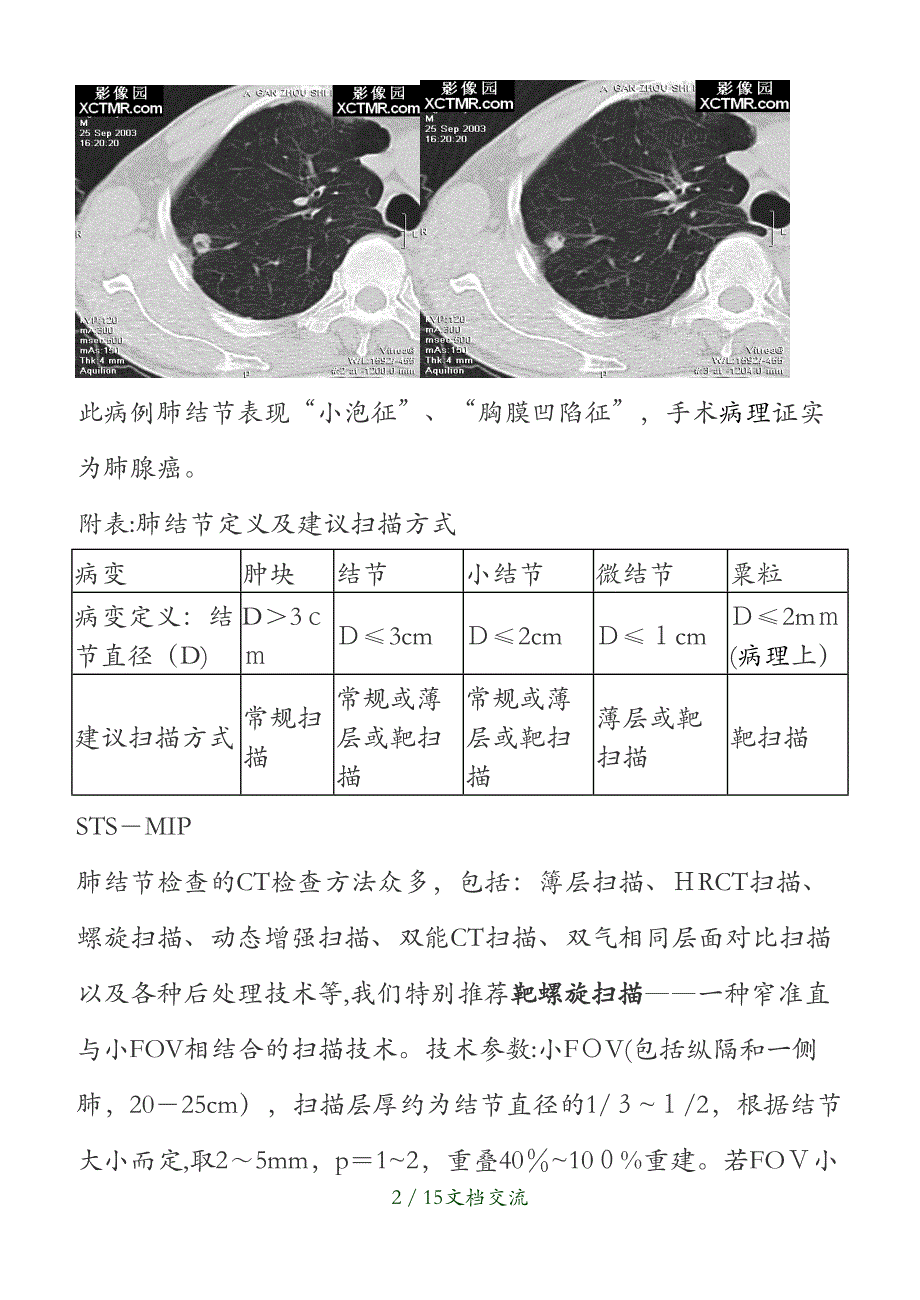 肺结节CT的征象及显示(干货分享)_第2页