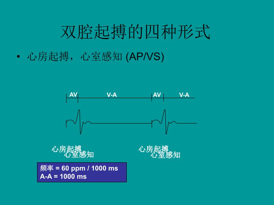 双腔起搏器技术及临床心电图表现PPT_第4页