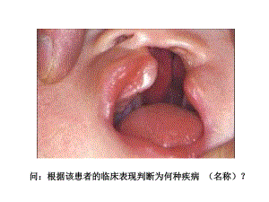 问根据该患者的临床表现判断为何种疾病（名称）